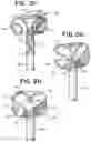 Fig. 05 - SEMISPHERICAL BRAIDED ANEURYSM TREATMENT SYSTEM AND METHOD