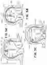 Fig. 11 - SEMISPHERICAL BRAIDED ANEURYSM TREATMENT SYSTEM AND METHOD