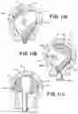 Fig. 15 - SEMISPHERICAL BRAIDED ANEURYSM TREATMENT SYSTEM AND METHOD