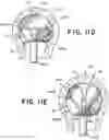 Fig. 16 - SEMISPHERICAL BRAIDED ANEURYSM TREATMENT SYSTEM AND METHOD