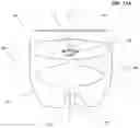 Fig. 20 - SEMISPHERICAL BRAIDED ANEURYSM TREATMENT SYSTEM AND METHOD