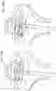 Fig. 30 - SEMISPHERICAL BRAIDED ANEURYSM TREATMENT SYSTEM AND METHOD