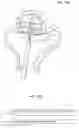 Fig. 31 - SEMISPHERICAL BRAIDED ANEURYSM TREATMENT SYSTEM AND METHOD