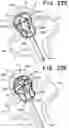 Fig. 44 - SEMISPHERICAL BRAIDED ANEURYSM TREATMENT SYSTEM AND METHOD