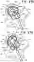Fig. 45 - SEMISPHERICAL BRAIDED ANEURYSM TREATMENT SYSTEM AND METHOD