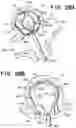 Fig. 47 - SEMISPHERICAL BRAIDED ANEURYSM TREATMENT SYSTEM AND METHOD