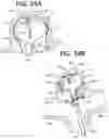 Fig. 50 - SEMISPHERICAL BRAIDED ANEURYSM TREATMENT SYSTEM AND METHOD