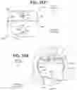 Fig. 52 - SEMISPHERICAL BRAIDED ANEURYSM TREATMENT SYSTEM AND METHOD