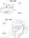 Fig. 55 - SEMISPHERICAL BRAIDED ANEURYSM TREATMENT SYSTEM AND METHOD