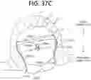 Fig. 56 - SEMISPHERICAL BRAIDED ANEURYSM TREATMENT SYSTEM AND METHOD