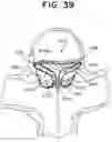 Fig. 58 - SEMISPHERICAL BRAIDED ANEURYSM TREATMENT SYSTEM AND METHOD
