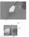 Fig. 02 - ORBITAL FLOOR IMPLANT