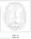 Fig. 02 - Method for performing single-stage cranioplasty reconstruction with a clear custom craniofacial implant
