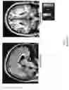 Fig. 02 - NON-INVASIVE PROPRIOCEPTIVE STIMULATION FOR TREATING EPILEPSY
