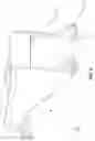 Fig. 22 - Apparatus and method for sealing a vascular puncture