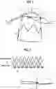 Fig. 02 - Stent graft