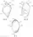 Fig. 02 - Carpometacarpal (CMC) implants and methods