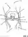 Fig. 02 - APPARATUS AND METHOD FOR STABILIZING A HUMAN ANATOMICAL JOINT