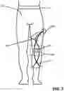 Fig. 03 - APPARATUS AND METHOD FOR STABILIZING A HUMAN ANATOMICAL JOINT