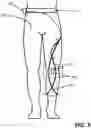 Fig. 04 - APPARATUS AND METHOD FOR STABILIZING A HUMAN ANATOMICAL JOINT