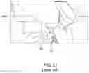 Fig. 22 - Combined Laser and Phacoemulsification System for Eye Surgery