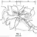 Fig. 02 - Eustachian tube dilation balloon with ventilation path