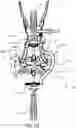 Fig. 167 - TISSUE RETRACTOR, RETRACTION MODULES, AND ASSOCIATED METHODS