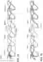 Fig. 43 - Variable denier yarn and suture