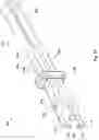 Fig. 49 - Bipolar coagulating devices and vasectomy kits associated therewith