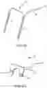 Fig. 10 - SINGLE ARCH MANDIBULAR ADVANCER