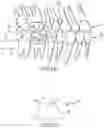 Fig. 15 - SINGLE ARCH MANDIBULAR ADVANCER