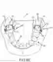 Fig. 16 - SINGLE ARCH MANDIBULAR ADVANCER