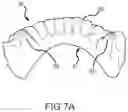 Fig. 17 - SINGLE ARCH MANDIBULAR ADVANCER