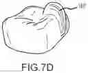Fig. 19 - SINGLE ARCH MANDIBULAR ADVANCER