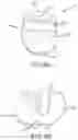 Fig. 20 - SINGLE ARCH MANDIBULAR ADVANCER