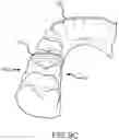 Fig. 23 - SINGLE ARCH MANDIBULAR ADVANCER