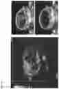 Fig. 06 - Methods and Compositions for Two-Stage Microbubble Delivery of Active Agents