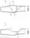 Fig. 08 - Biological valve for venous insufficiency
