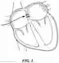 Fig. 02 - IMPLANTABLE SHUNT SYSTEMS AND METHODS