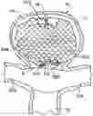 Fig. 01 - ANEURYSM TREATMENT DEVICE