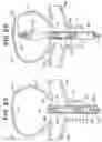 Fig. 03 - ANEURYSM TREATMENT DEVICE