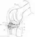 Fig. 01 - ARRANGEMENT AND METHOD USED IN THE PREPARATION OF BONE SURFACES OF THE KNEE JOINT FOR THE COMPONENTS OF A PROSTHETIC KNEE JOINT