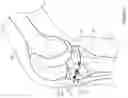 Fig. 06 - ARRANGEMENT AND METHOD USED IN THE PREPARATION OF BONE SURFACES OF THE KNEE JOINT FOR THE COMPONENTS OF A PROSTHETIC KNEE JOINT