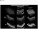 Fig. 13 - OPTIMIZED GENE THERAPY TARGETING RETINAL CELLS