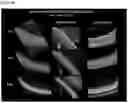 Fig. 14 - OPTIMIZED GENE THERAPY TARGETING RETINAL CELLS