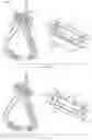Fig. 32 - METHODS AND DEVICES FOR TISSUE GRAFT FIXATION