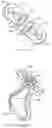 Fig. 35 - METHODS AND DEVICES FOR TISSUE GRAFT FIXATION