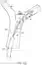 Fig. 06 - Single insertion delivery system for treating embolism and associated systems and methods