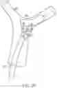 Fig. 09 - Single insertion delivery system for treating embolism and associated systems and methods