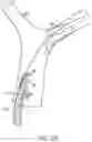 Fig. 10 - Single insertion delivery system for treating embolism and associated systems and methods